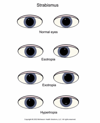 strabismus