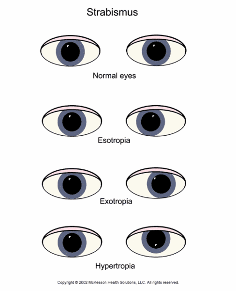 Strabismus Vision Example Strabismus | Dr. Victor Pegado